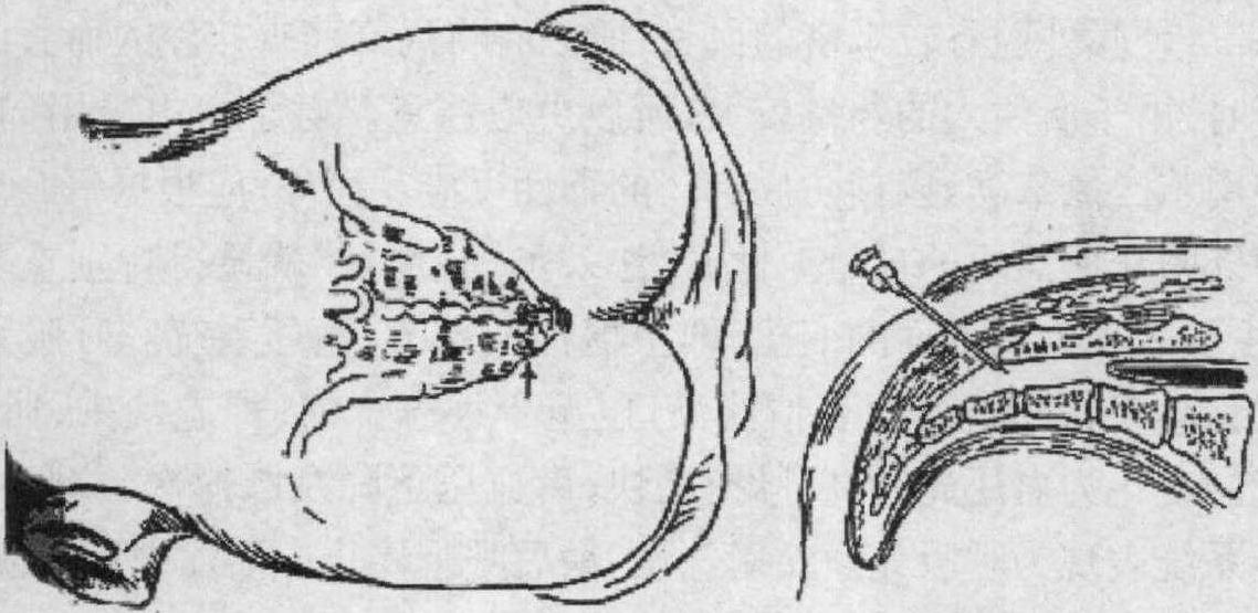 第四節(jié) 椎管內(nèi)阻滯